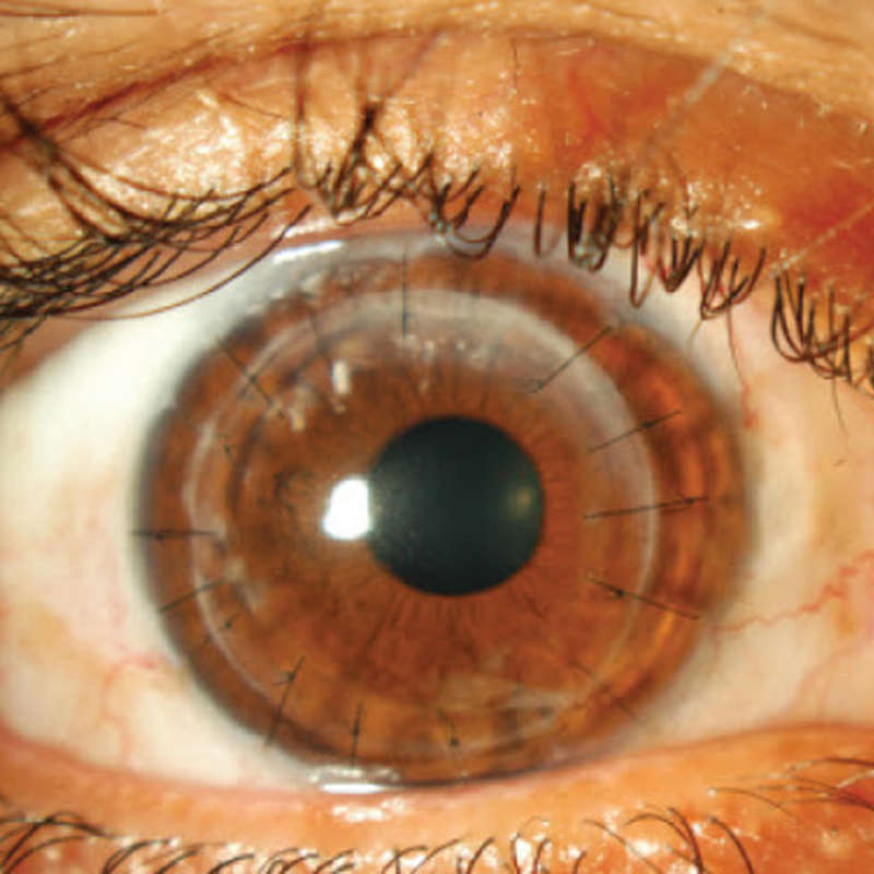 Keratoplasties